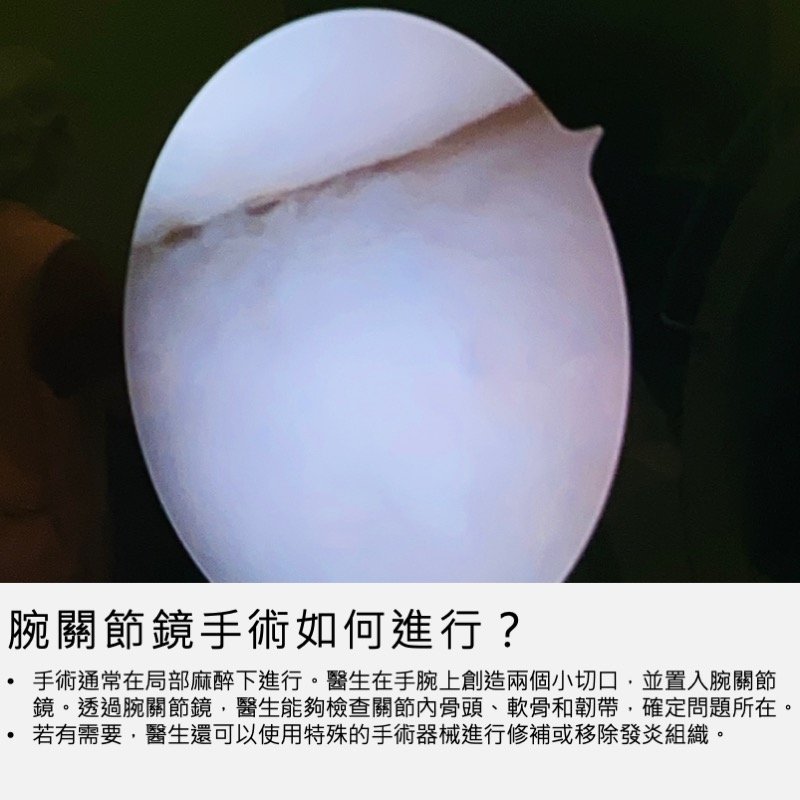 腕節鏡手術如何進行?
