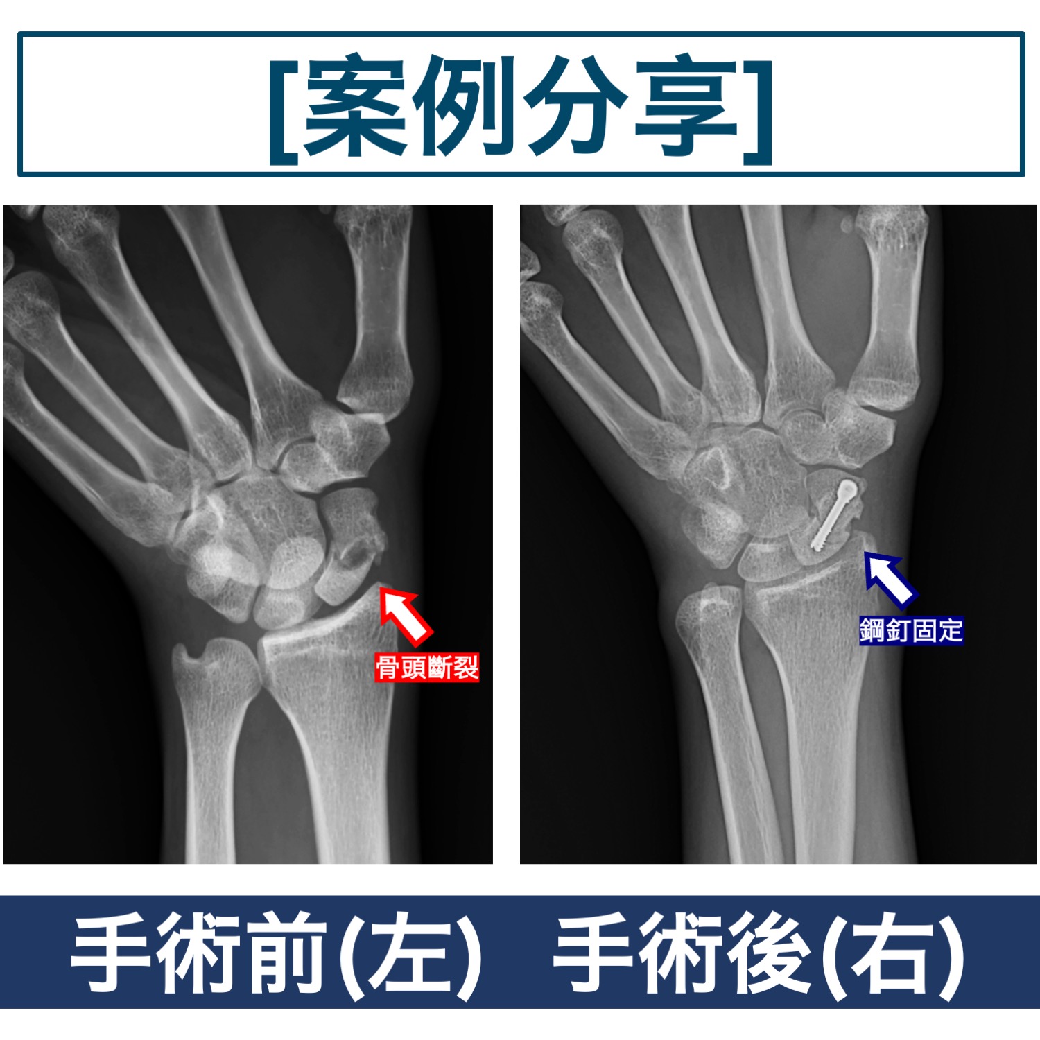 腕舟骨骨折不连接的手术治疗-外科学-医学